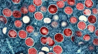 monkeypox mpox